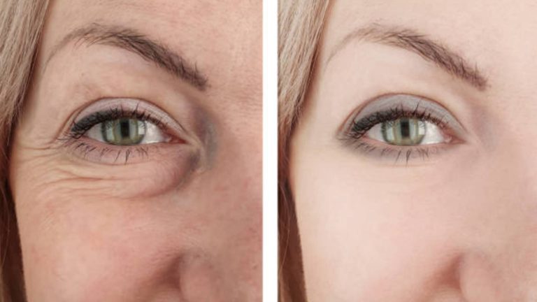Is Botox Better Or Worse Than Deep Wrinkle Cream?