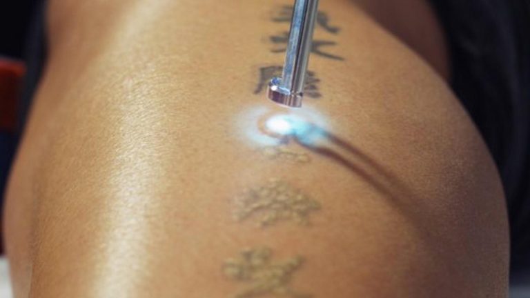 Tips To Choose A Tattoo Removal Clinic At Affordable Prices